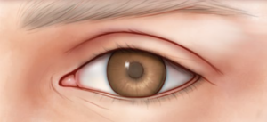 Bovenste ooglidcorrectie na de ingreep