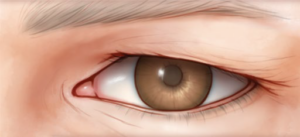 Bovenste ooglidcorrectie voor de ingreep