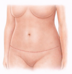 abdominoplastie postop