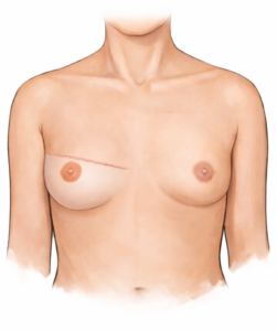 borstreconstructie postop