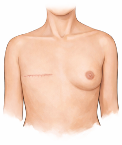 borstreconstructie preop